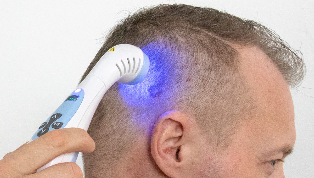 Ozařování pokožky hlavy UV světlem