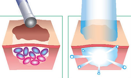 Fotodynamická terapie na pokožku - infografika