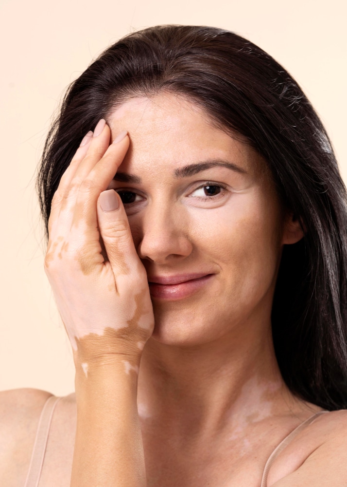 Seběvědomá žena s vitiligem na tváři a ruce